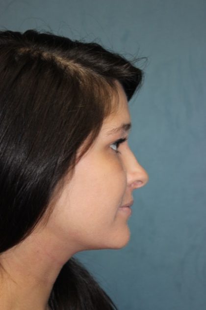 Rhinoplasty Before & After Patient #3943