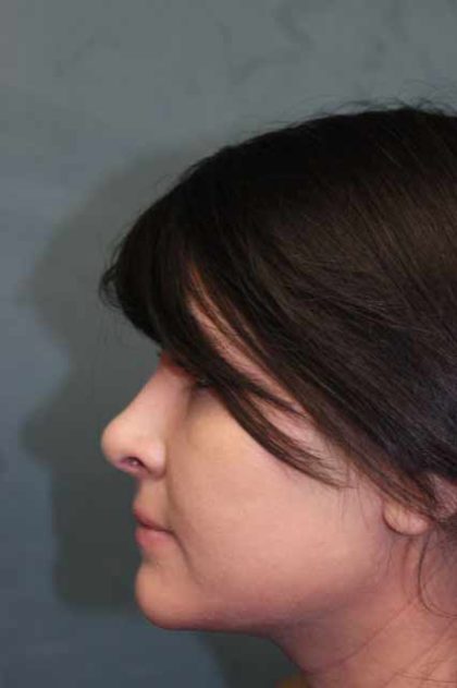 Rhinoplasty Before & After Patient #3943