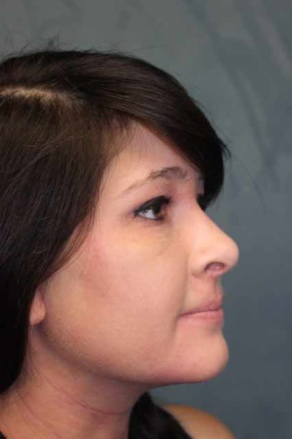 Rhinoplasty Before & After Patient #3943