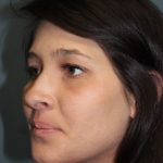 Rhinoplasty Before & After Patient #3943