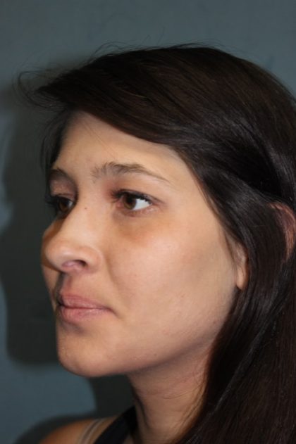 Rhinoplasty Before & After Patient #3943