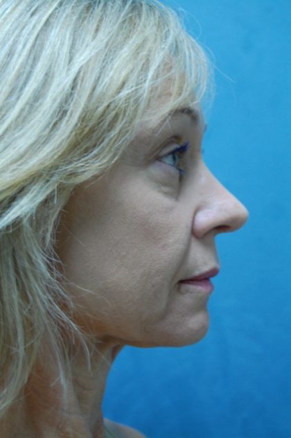 Rhinoplasty Before & After Patient #3810