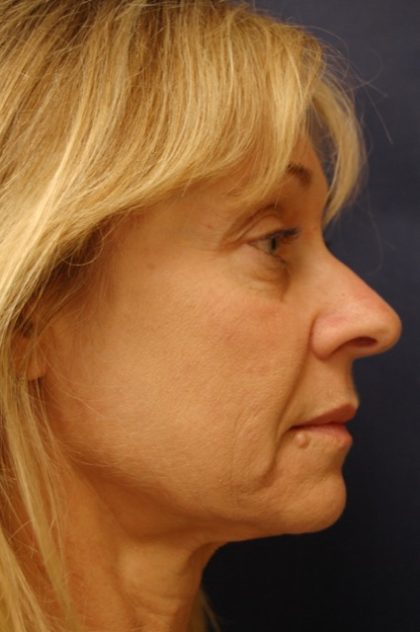 Rhinoplasty Before & After Patient #3810