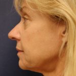 Rhinoplasty Before & After Patient #3810