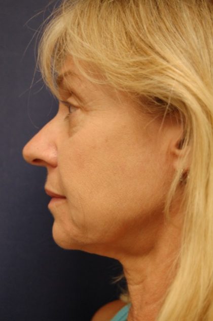 Rhinoplasty Before & After Patient #3810