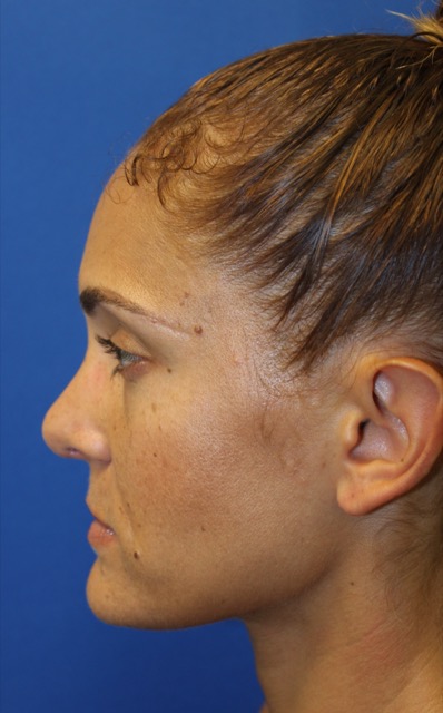 Rhinoplasty Before & After Patient #3885