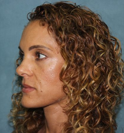 Rhinoplasty Before & After Patient #3885