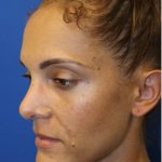 Rhinoplasty Before & After Patient #3885