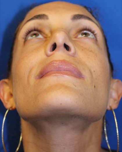 Rhinoplasty Before & After Patient #3885