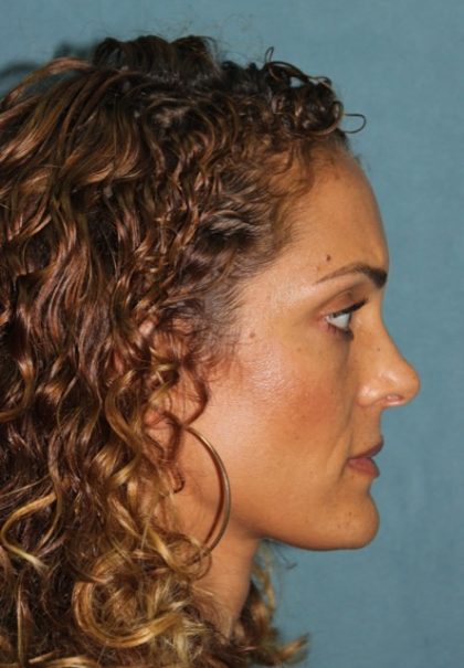 Rhinoplasty Before & After Patient #3885