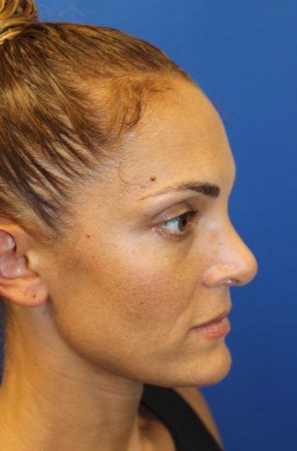 Rhinoplasty Before & After Patient #3885