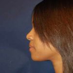 Rhinoplasty Before & After Patient #4082