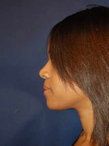 Rhinoplasty Before & After Patient #4082