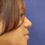 Rhinoplasty Before & After Patient #4082