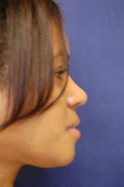 Rhinoplasty Before & After Patient #4082