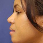 Rhinoplasty Before & After Patient #4082