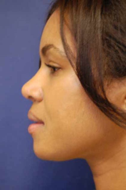 Rhinoplasty Before & After Patient #4082