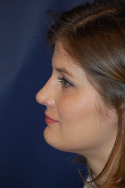 Rhinoplasty Before & After Patient #3649