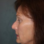 Rhinoplasty Before & After Patient #3821