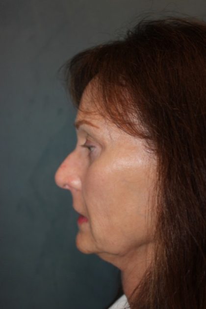 Rhinoplasty Before & After Patient #3821