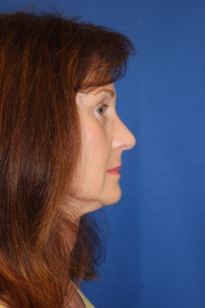 Rhinoplasty Before & After Patient #3821