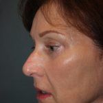 Rhinoplasty Before & After Patient #3821