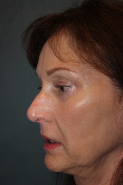 Rhinoplasty Before & After Patient #3821