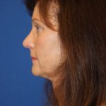 Rhinoplasty Before & After Patient #3821