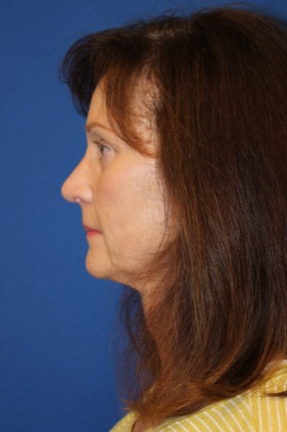 Rhinoplasty Before & After Patient #3821