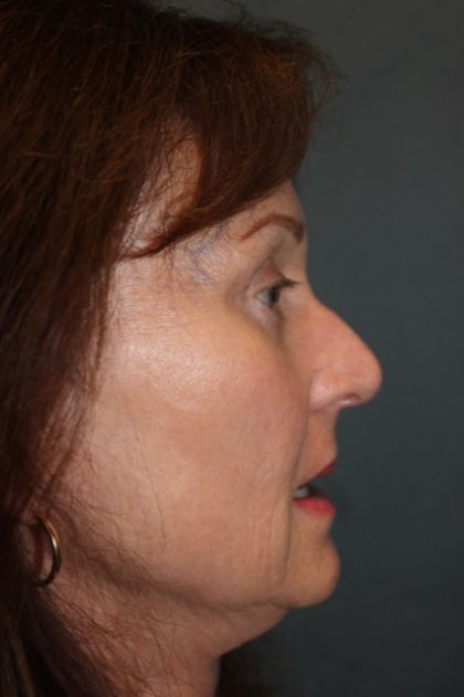 Rhinoplasty Before & After Patient #3821