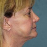 Rhinoplasty Before & After Patient #4064