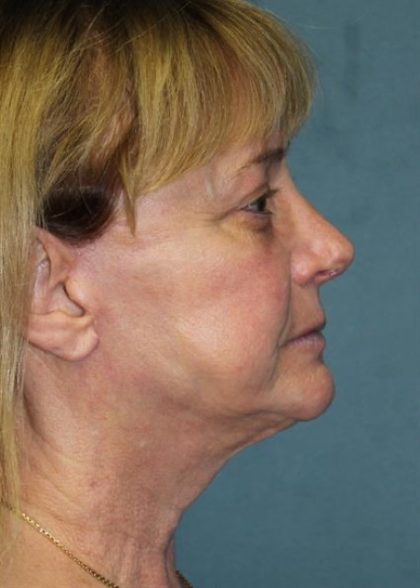 Rhinoplasty Before & After Patient #4064