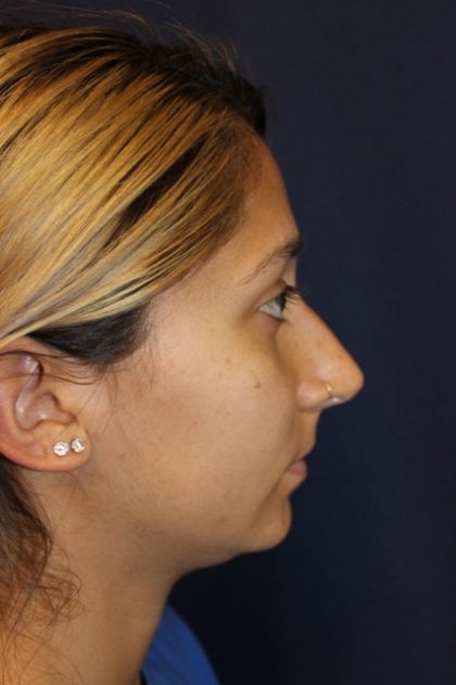 Rhinoplasty Before & After Patient #3762