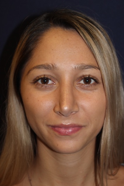 Rhinoplasty Before & After Patient #3762