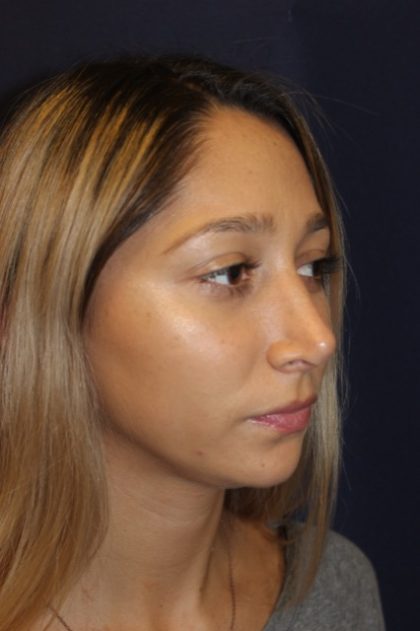 Rhinoplasty Before & After Patient #3762