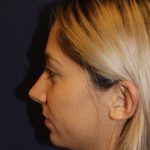 Rhinoplasty Before & After Patient #3762