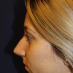 Rhinoplasty Before & After Patient #3762