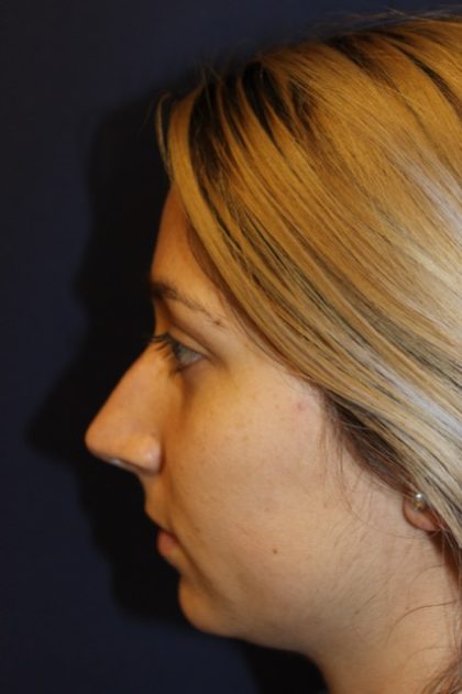 Rhinoplasty Before & After Patient #3762