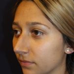 Rhinoplasty Before & After Patient #3762