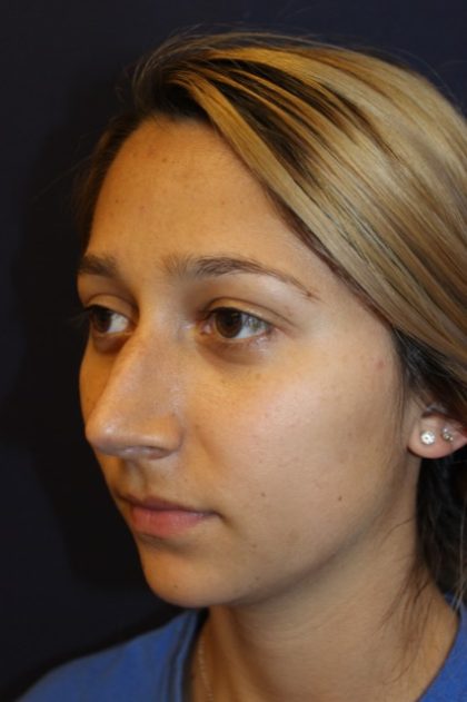 Rhinoplasty Before & After Patient #3762