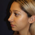 Rhinoplasty Before & After Patient #3762