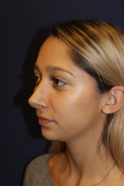 Rhinoplasty Before & After Patient #3762