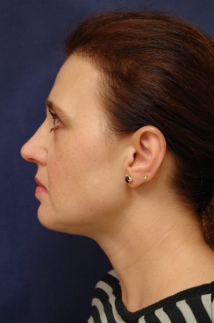 Rhinoplasty Before & After Patient #4092