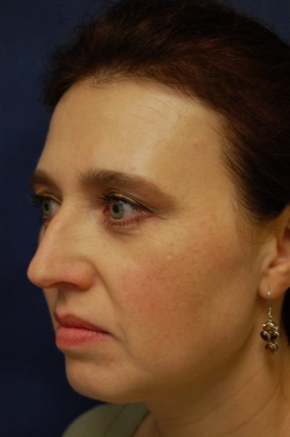 Rhinoplasty Before & After Patient #4092