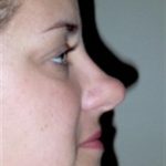 Rhinoplasty Before & After Patient #3956