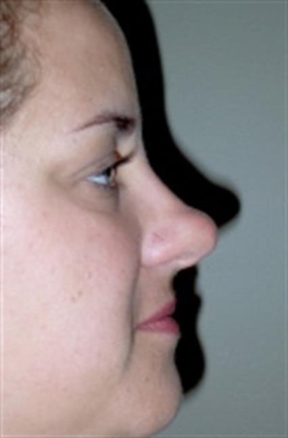 Rhinoplasty Before & After Patient #3956