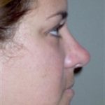 Rhinoplasty Before & After Patient #3956