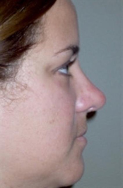 Rhinoplasty Before & After Patient #3956
