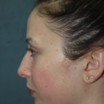 Rhinoplasty Before & After Patient #3686