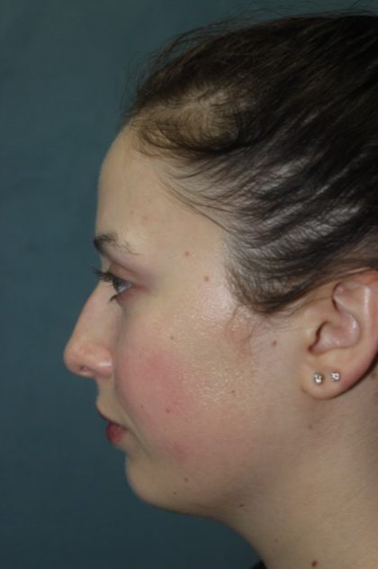 Rhinoplasty Before & After Patient #3686